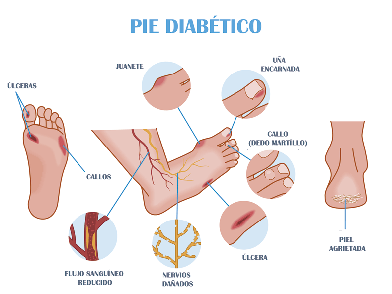 Característica del pie diabético