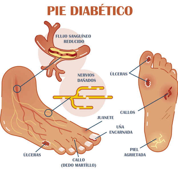 Características del pie diabético