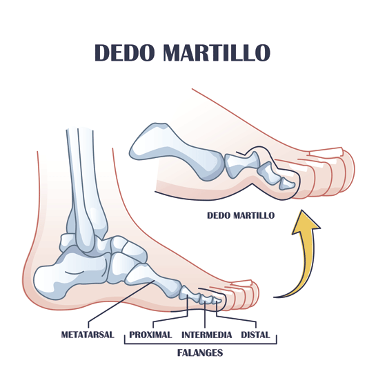 ilustracion dedo en martillo y huesos del pie 