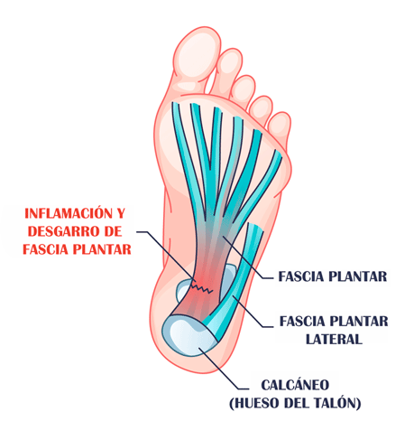 ilustración de inflamación en fascia plantar y desgarro por fascitis plantar