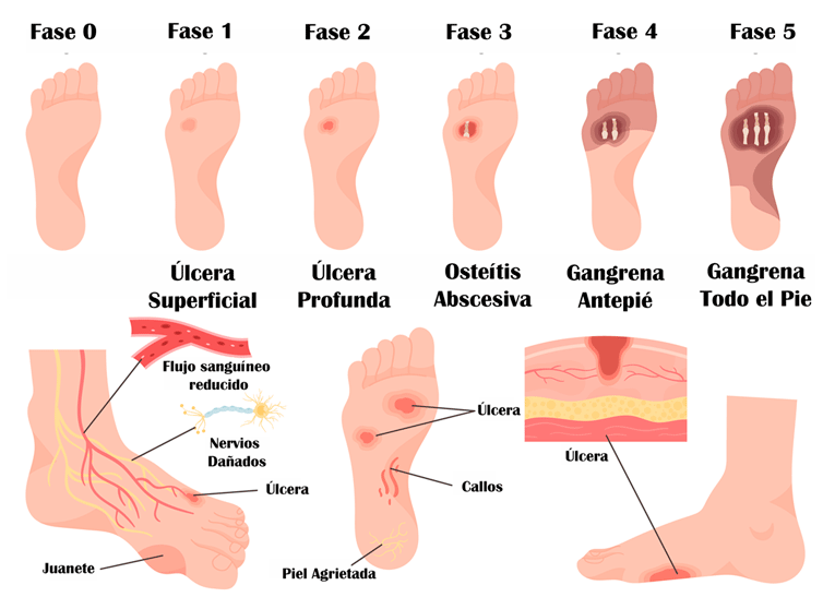 Fases del pie diabético
