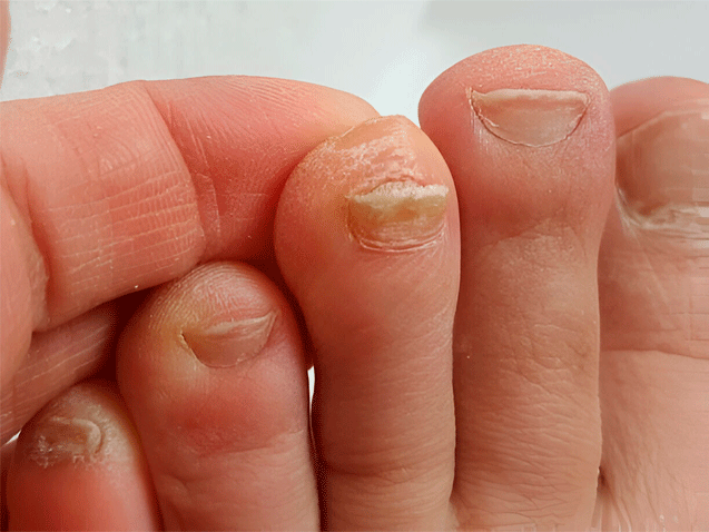 sintomas unas de los pies con hongos