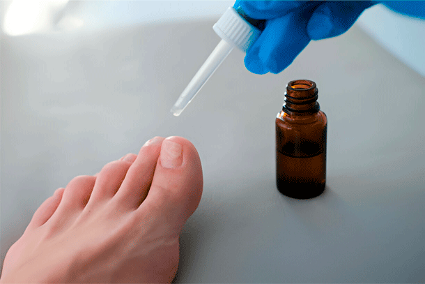 tratamiento farmacologico hongos en uña del pie